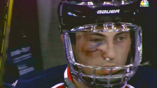 Blue Jackets' Zach Werenski Returns To Game After Taking Puck To The Face Like It's No Big Deal